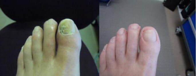 Fotos der Füße vor und nach der Anwendung der Zenidol-Creme