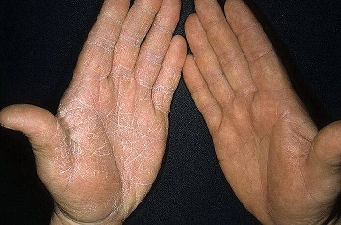 Symptome eines Pilzes auf der Haut der Hände