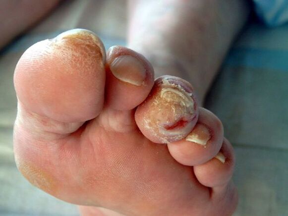 Diabetischer Fuß und Onychomykose